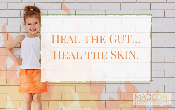 Your gut may be the cause of your eczema.